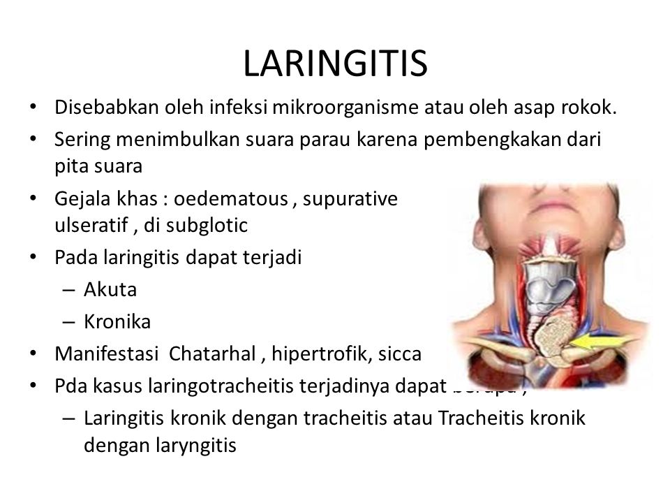 Que tomar para laringitis